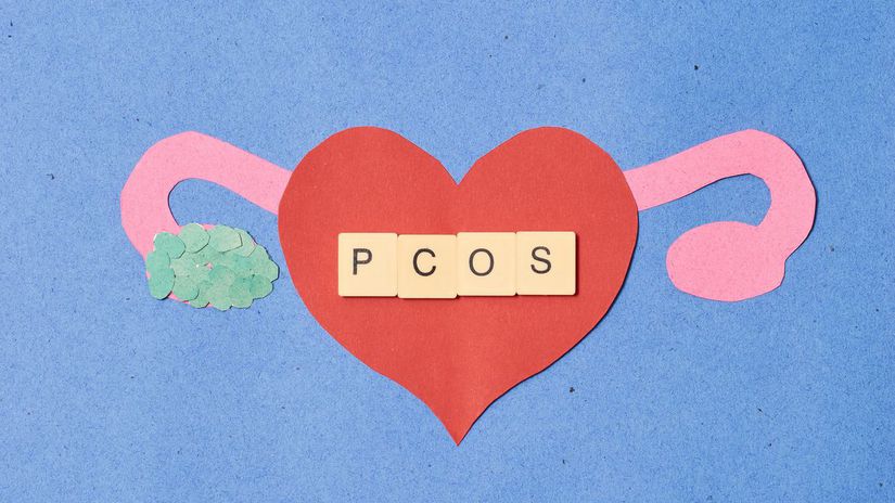Vedci priznal obrovsky omyl Chorobu milionov zien cele desatrocia zle pomenovali Preco ma byvaly syndrom PCOS nove meno